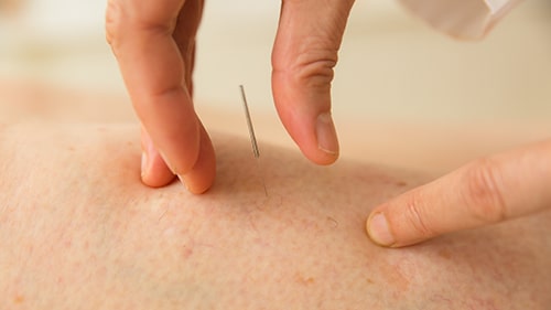 a person performing dry needling